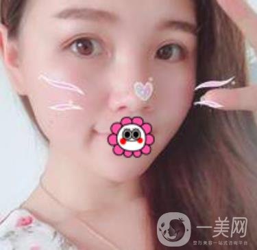 河南省人民醫(yī)院誰(shuí)做雙眼皮好？附案例及2020整形價(jià)格表