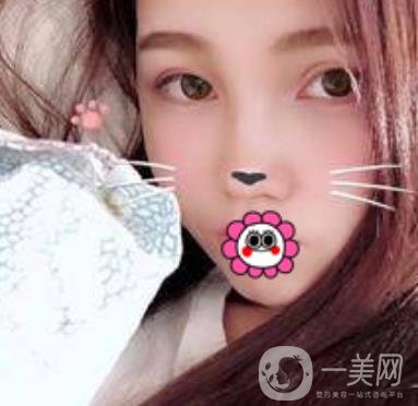 河南省人民醫(yī)院誰(shuí)做雙眼皮好？附案例及2020整形價(jià)格表