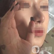 遼寧省人民醫(yī)院美容科怎么樣？附袁繼龍隆鼻案例