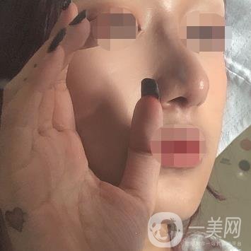 遼寧省人民醫(yī)院美容科怎么樣？附袁繼龍隆鼻案例