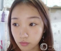 北大醫(yī)院美容價格表，附自體脂肪填充面部前后照