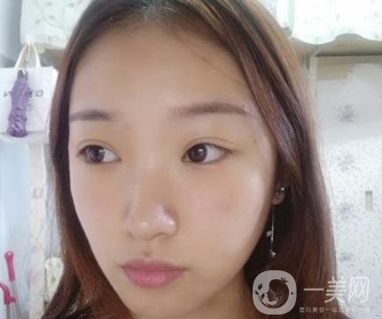 北大醫(yī)院美容價(jià)格表，附自體脂肪填充面部前后照