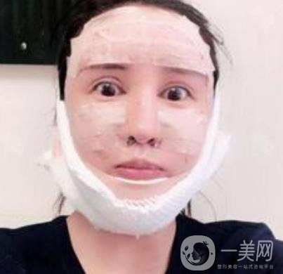 北大醫(yī)院美容價(jià)格表，附自體脂肪填充面部前后照