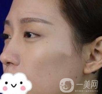 交大一附院何林做雙眼皮好嗎？價格表及術(shù)后*果分享