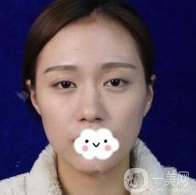交大一附院何林做雙眼皮好嗎？價格表及術(shù)后*果分享