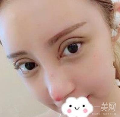 交大一附院何林做雙眼皮好嗎？價格表及術(shù)后*果分享