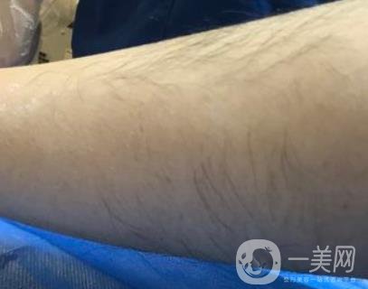 廈門中醫(yī)院陳華脫毛靠譜嗎？價(jià)格表及案例*果一覽