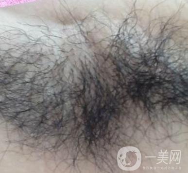 廈門中醫(yī)院陳華脫毛靠譜嗎？價(jià)格表及案例*果一覽