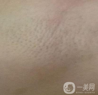 廈門中醫(yī)院陳華脫毛靠譜嗎？價(jià)格表及案例*果一覽