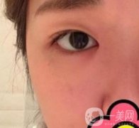 山大二院整形科2020價格表公布,附雙眼皮案例術(shù)后果圖