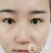 長海醫(yī)院邢新做雙眼皮修復(fù)好嗎？價格表及案例詳情一覽