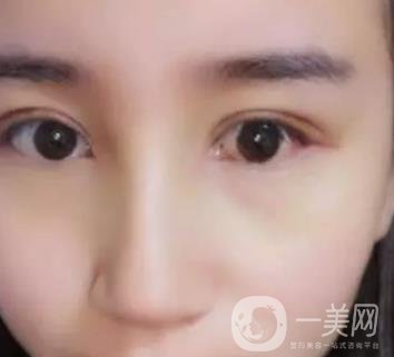 長海醫(yī)院邢新做雙眼皮修復好嗎？價格表及案例詳情一覽