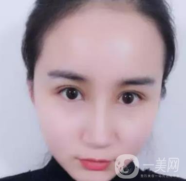 長海醫(yī)院邢新做雙眼皮修復好嗎？價格表及案例詳情一覽