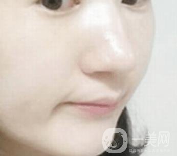 南通大學(xué)附屬醫(yī)院整形科價(jià)格表，附激光去疤案例