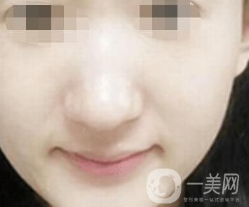 南通大學(xué)附屬醫(yī)院整形科價(jià)格表，附激光去疤案例