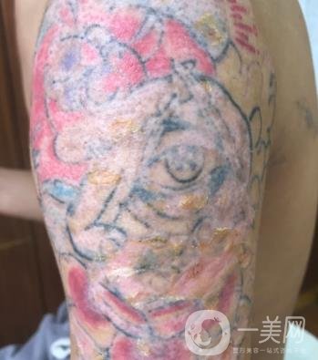 徐州市中心醫(yī)院整形科價(jià)格表，附洗紋身案例