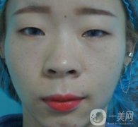 北京彤美醫(yī)療整形醫(yī)院價格表，附桂行軍雙眼皮術(shù)后果一覽
