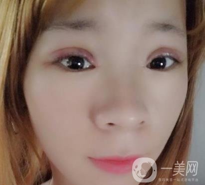 北京彤美醫(yī)療整形醫(yī)院價(jià)格表，附桂行軍雙眼皮術(shù)后*果一覽