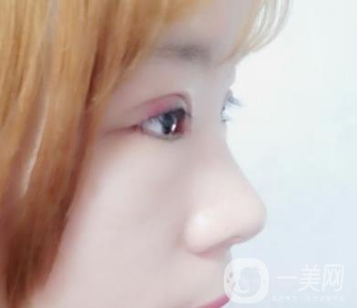 北京彤美醫(yī)療整形醫(yī)院價(jià)格表，附桂行軍雙眼皮術(shù)后*果一覽