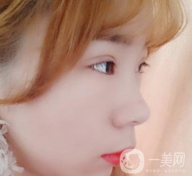 北京彤美醫(yī)療整形醫(yī)院價(jià)格表，附桂行軍雙眼皮術(shù)后*果一覽