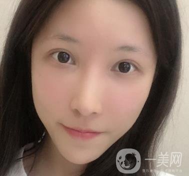 成都華美醫(yī)院做眉毛怎么樣?真實*果圖和價格一覽表展示