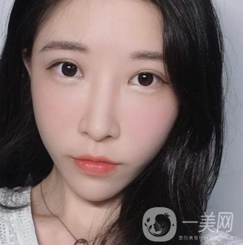 成都華美醫(yī)院做眉毛怎么樣?真實*果圖和價格一覽表展示