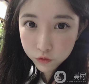 成都華美醫(yī)院做眉毛怎么樣?真實*果圖和價格一覽表展示