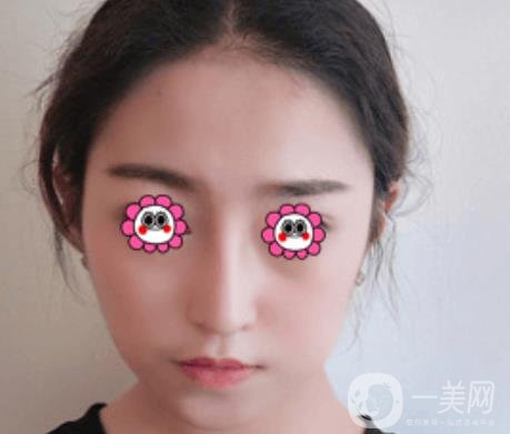 北京圣嘉榮整形價格表，內附黃大勇整形醫(yī)生顴骨內推案例*果圖展示