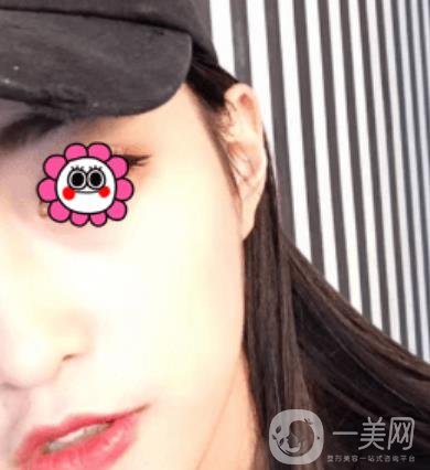 北京圣嘉榮整形價格表，內附黃大勇整形醫(yī)生顴骨內推案例*果圖展示