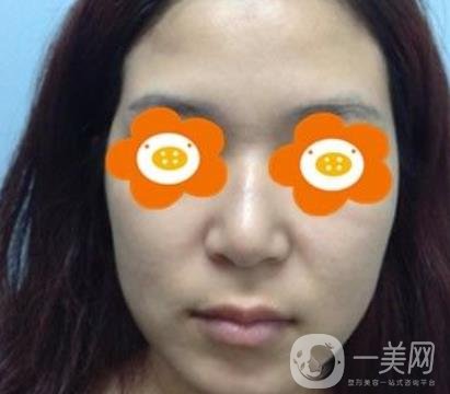 長(zhǎng)沙貝美醫(yī)院做鼻子怎么樣?一覽價(jià)格表費(fèi)用詳情