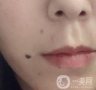 重慶附一院整形科價格表2020年公布，附祛痣整形日記