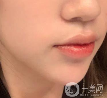 重慶附一院整形科價(jià)格表2020年公布，附祛痣整形日記