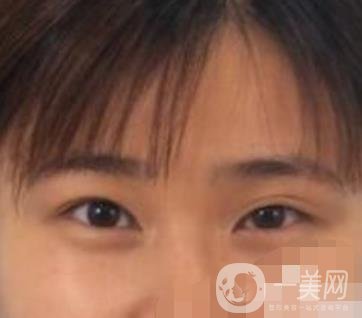 北京韓勛雙眼皮修復(fù)怎么樣？附整形價(jià)格表一覽