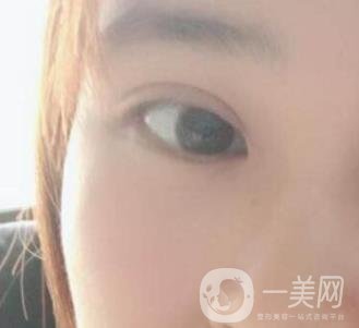 北京韓勛雙眼皮修復(fù)怎么樣？附整形價(jià)格表一覽