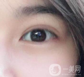 北京韓勛雙眼皮修復(fù)怎么樣？附整形價(jià)格表一覽