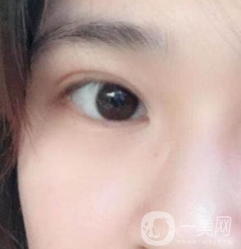 北京韓勛雙眼皮修復(fù)怎么樣？附整形價(jià)格表一覽