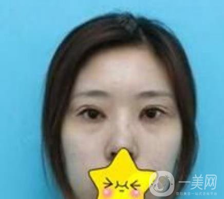 濟寧附屬醫(yī)院做雙眼皮多少錢？附真實案例及整形價格表