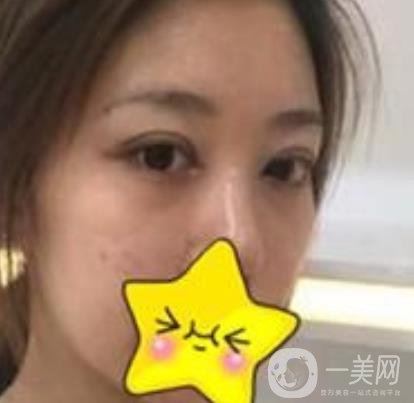濟寧附屬醫(yī)院做雙眼皮多少錢？附真實案例及整形價格表