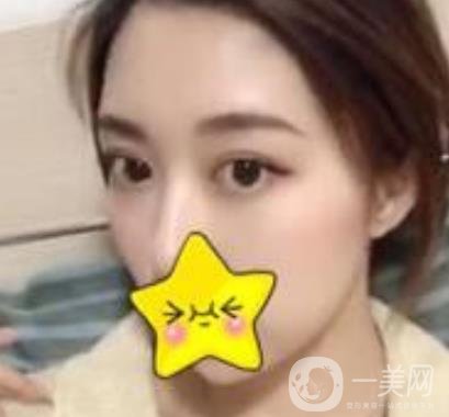 濟寧附屬醫(yī)院做雙眼皮多少錢？附真實案例及整形價格表