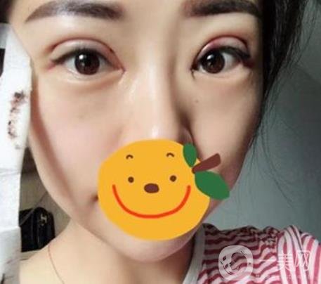 昆明市第一人民醫(yī)院雙眼皮多少錢？附案例及2020全新整形價格表