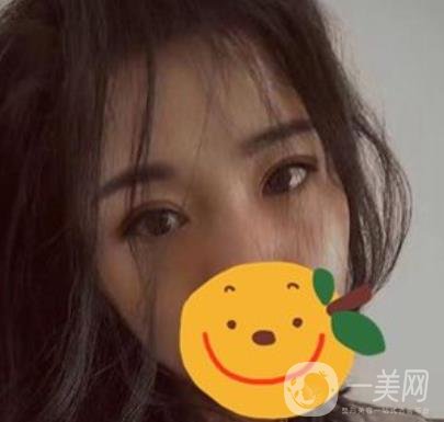 昆明市第一人民醫(yī)院雙眼皮多少錢？附案例及2020全新整形價格表
