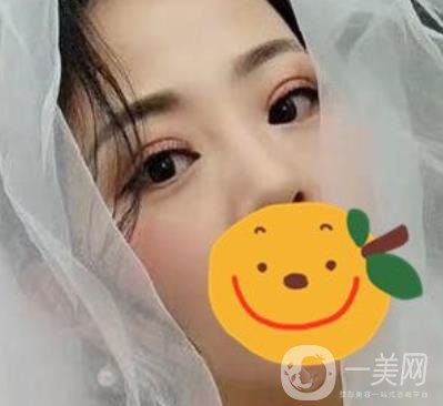 昆明市第一人民醫(yī)院雙眼皮多少錢？附案例及2020全新整形價格表