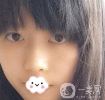 劉波醫(yī)生隆鼻修復(fù)