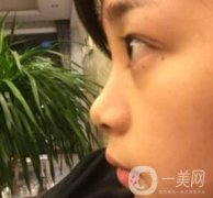 上海瑞金醫(yī)院王輝隆鼻價(jià)格一覽表，附整形案例在線展示