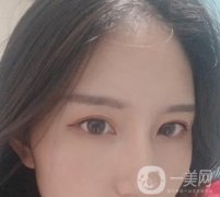北京處布仁醫(yī)生隆鼻案例，看整形價(jià)格及果怎么樣