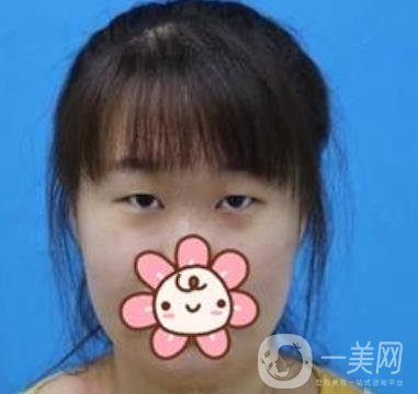 上海華美楊亞益做眼睛多少錢？價(jià)格表及案例詳情