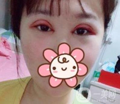 上海華美楊亞益做眼睛多少錢？價(jià)格表及案例詳情