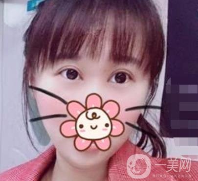 上海華美楊亞益做眼睛多少錢？價(jià)格表及案例詳情