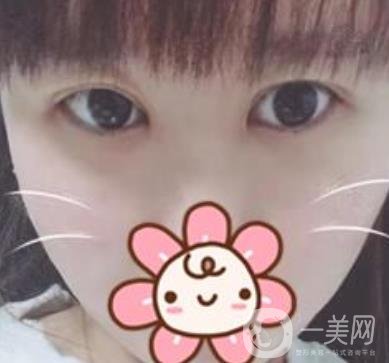 上海華美楊亞益做眼睛多少錢？價(jià)格表及案例詳情
