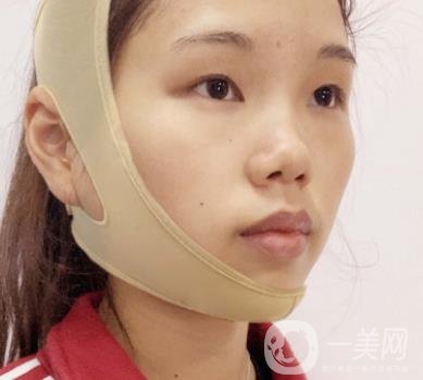 上海時光醫(yī)院何晉龍磨骨怎么樣？價格表及術(shù)后*果分享